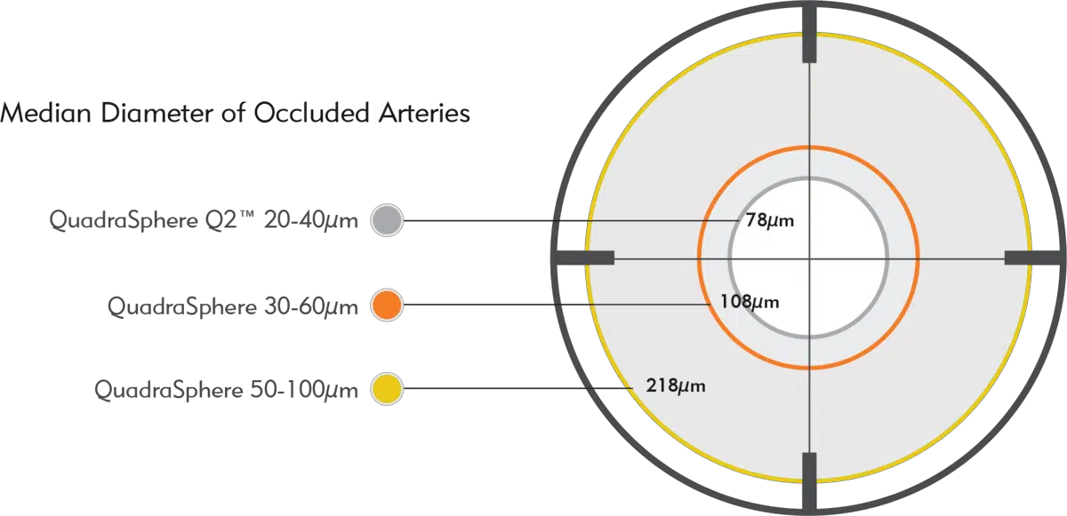 Image shows median diameter of occluded arteries by Quadrasphere sizes