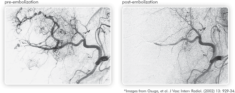 QuadrasphereMicrospheres-embolization