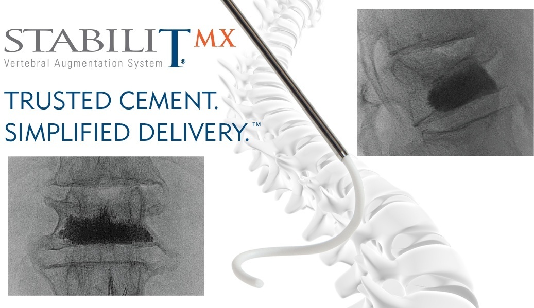 StabiliT Bone Cement Trusted Cement. Simplified Delivery. Merit Medical
