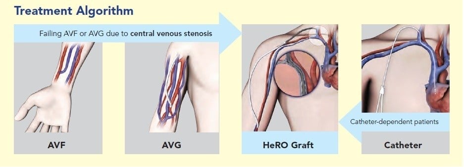 HeRO Graft - Hemodialysis Reliable Outflow