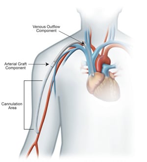 HeRO Graft - Cannulation Area for HeRO
