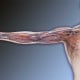 HeRO™ Graft Bypasses Central Venous Stenosis, Improves Hemodialysis