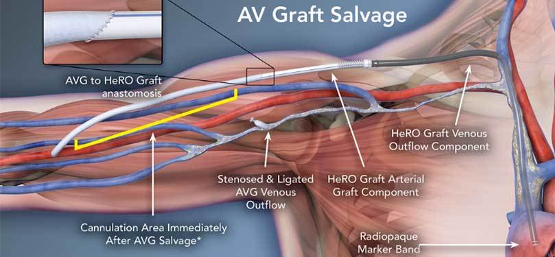 image-AV-Graft-Salvage
