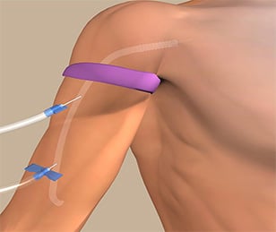HeRO Graft - Hemodialysis Reliable Outflow