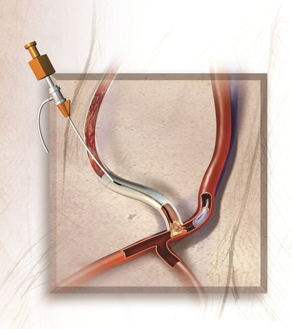 Thrombectomy With Balloon - Arterial Plug Removal - HeRO Graft