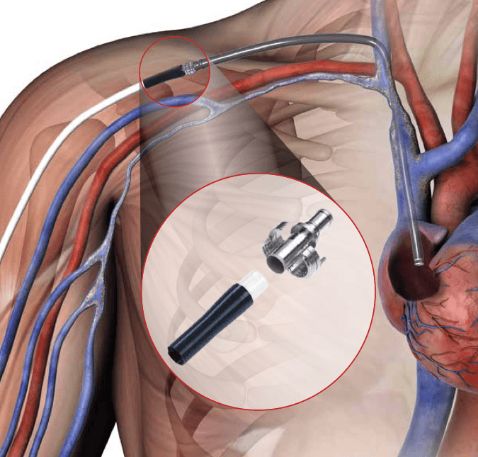 What Is the Super HeRO? Merit Medical