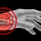 Distal Transradial Access Is Taking Social Media by Storm
