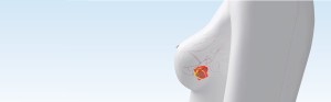 Tumor Localization - showing a breast in profile with a tumor in red and orange