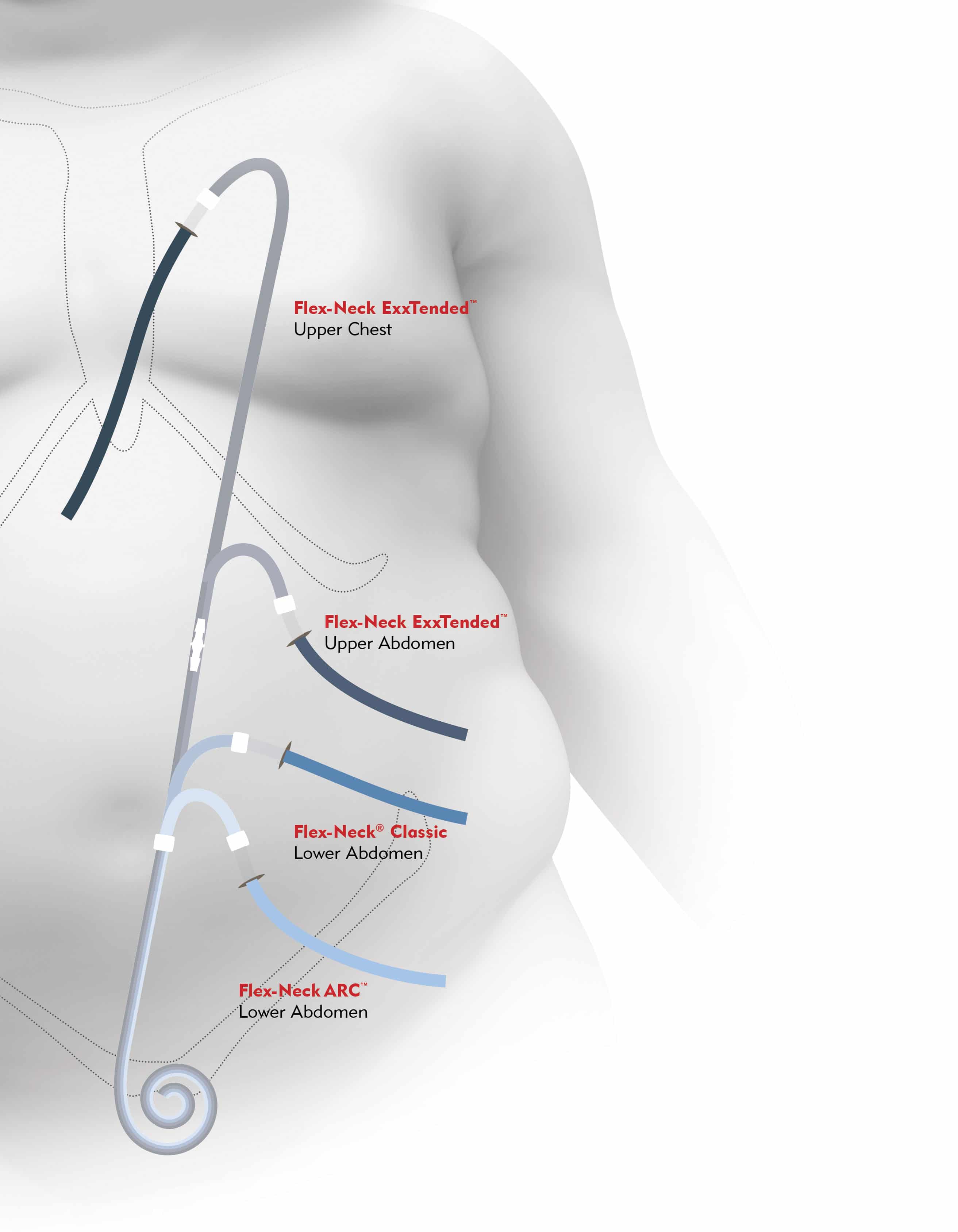 PD Catheter Placement in the body showing upper chest and abdomen, lower abdomen, and catheters with and without curves