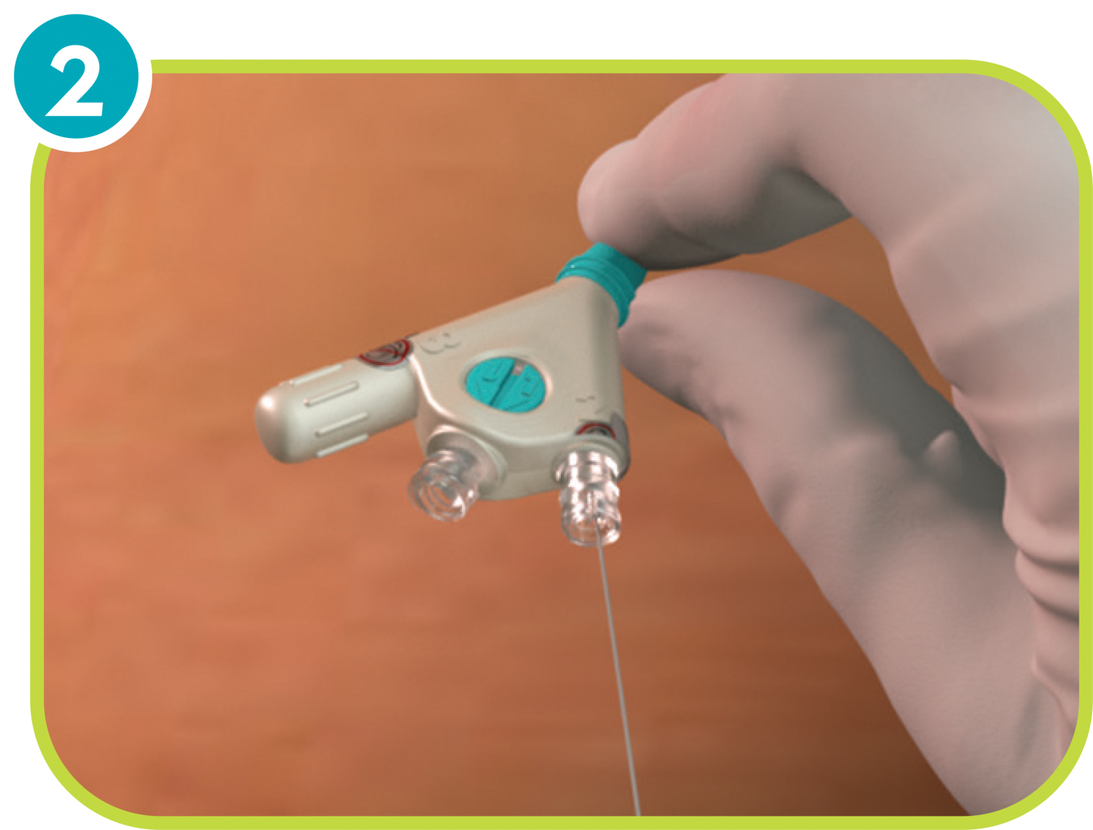 ReSolve ConvertX® Nephroureteral Stent System Merit Medical