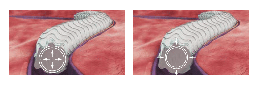 Merit WRAPSODY™ Cell-Impermeable Endoprosthesis- RADIAL STRENGTH AND COMPRESSION RESISTANCE