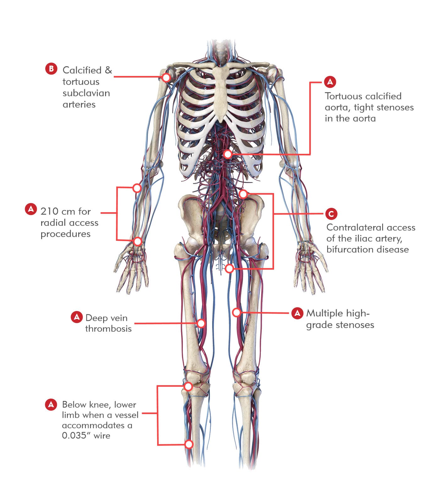 Multiple tip configurations for complex procedures - GO2 Steerable Guide Wire - Merit Medical