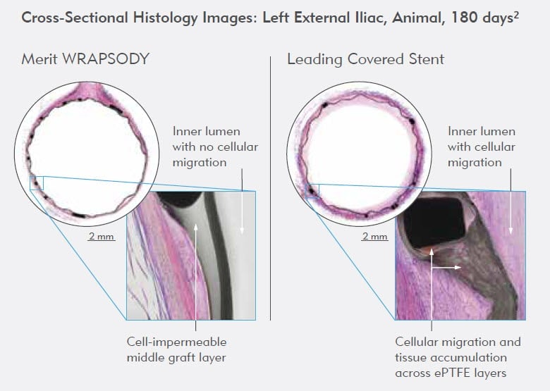 Cell-Impermeable Middle Graft Layer - Merit WRAPSODY - Merit Medical - Endoprosthesis Graft