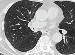 Pulmonary Stricture Management - Case Study 1 - Merit Endoscopy