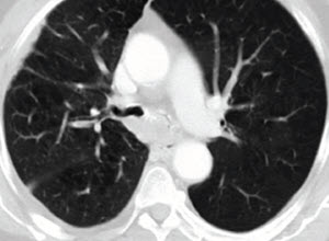 Pulmonary Stricture Management - Case Study 3 - Merit Endoscopy