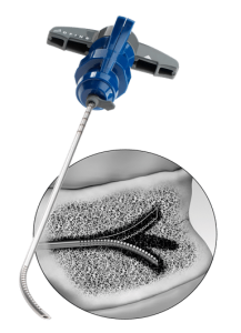 Solução StabiliT MX - Fratura por Compressão Vertebral VCF - DIREÇÃO. DESTREZA. CONTROLE - Mérito Médico