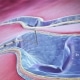 ClariVein® OC Provides Varicose Vein Relief, Less Pain Than Radiofrequency Ablation, Similar Quality of Life Outcomes