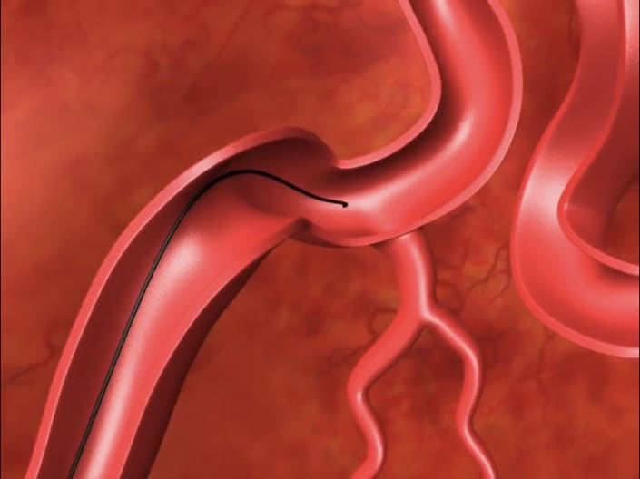 SplashWire Hydrophilic Steerable Guide Wire Merit Medical