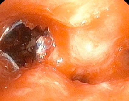 AEROmini - Treatment of Right Middle Lobe Stenosis