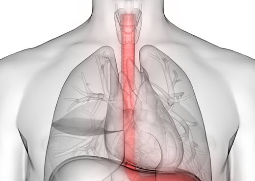 Understanding Esophageal Cancer