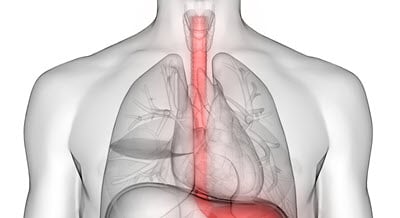 Esophageal Cancer