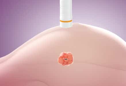 Step 1 - Informed Pre-Surgical Planning