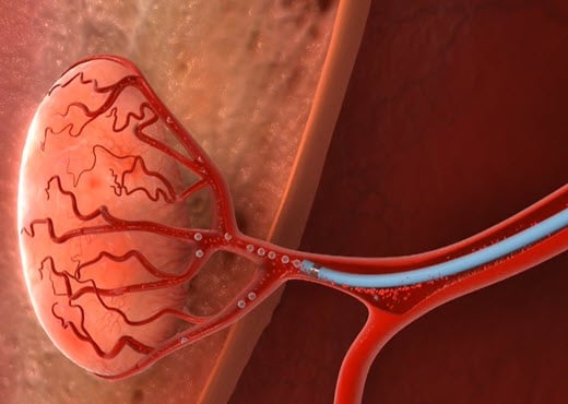 Uterine Fibroid Embolization - Embosphere Microspheres