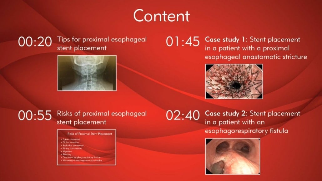 Proximal Esophageal EndoMAXX Stent Placement