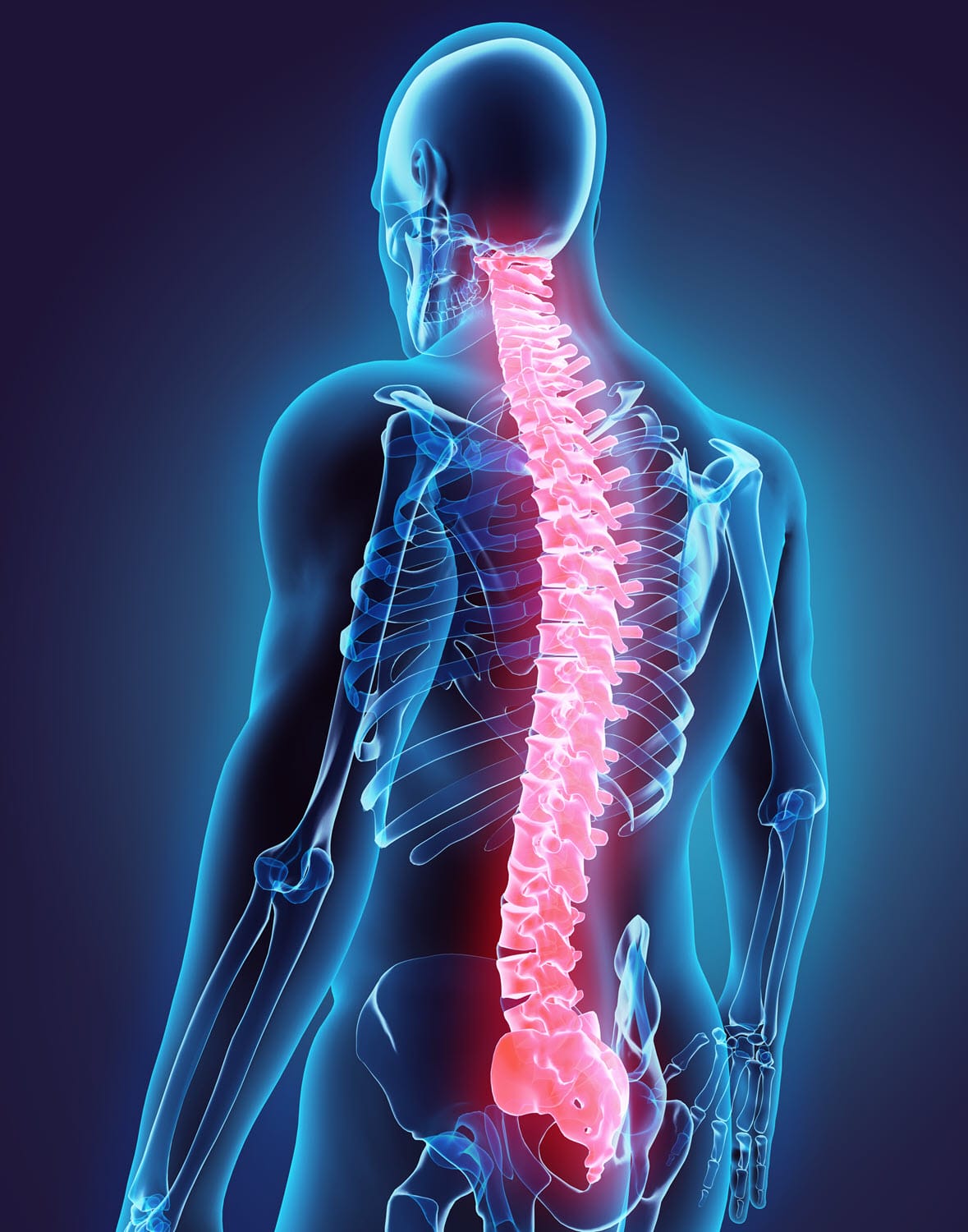 Aumento Vertebral para Fraturas por Compressão Vertebral (VCF)