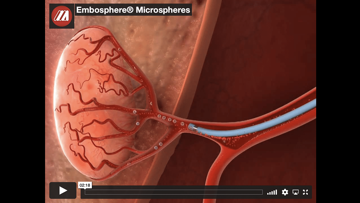 Embosphere® Microspheres - Consistent Clinic Results - Merit Medical