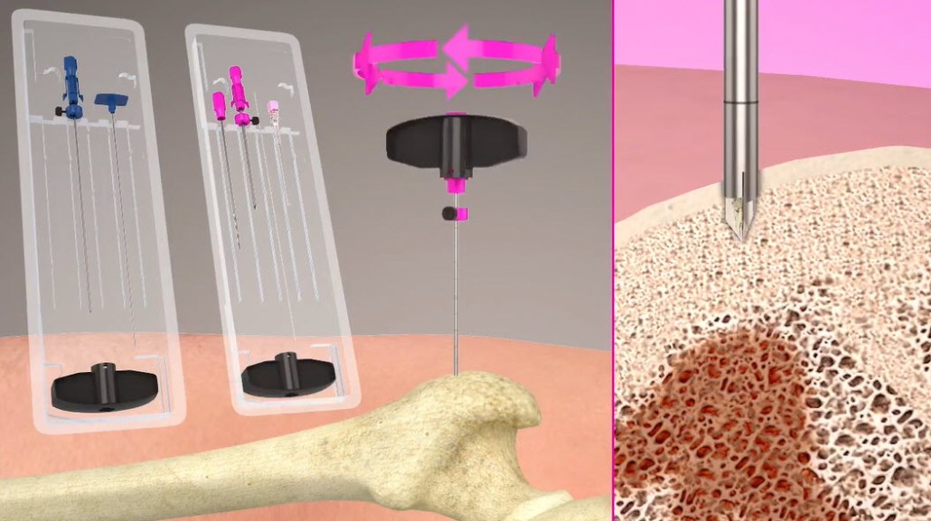 HUNTINGTON BONE BIOPSY SYSTEM PROCEDURE