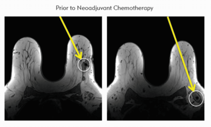 prior to neoadjuvant chemotherapy