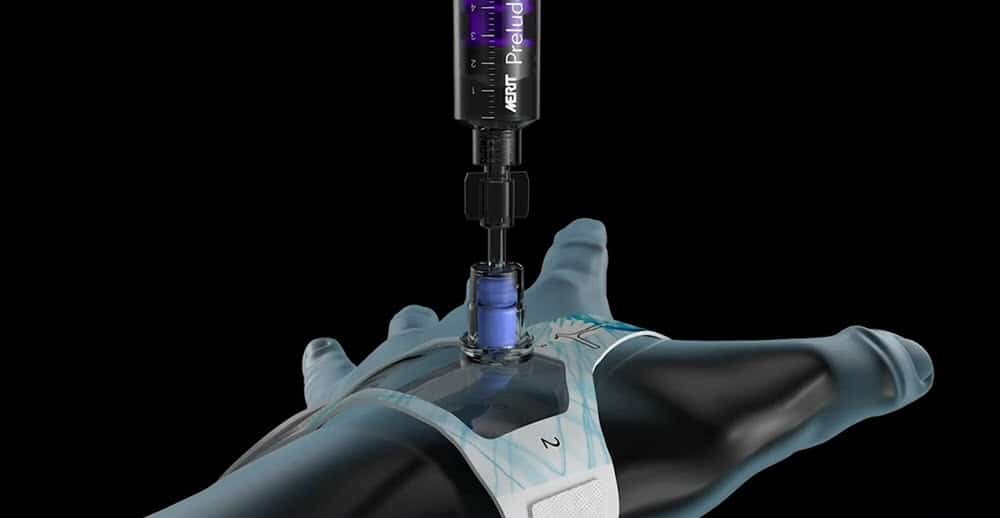 PRELUDESYNC DISTAL: FEATURING THE SLIP-N-LOCK ADAPTER IN-SERVICE