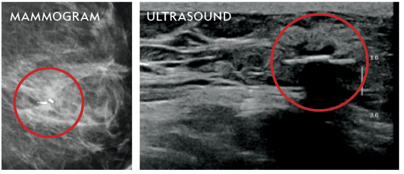 Images of a mammogram and ultrasound
