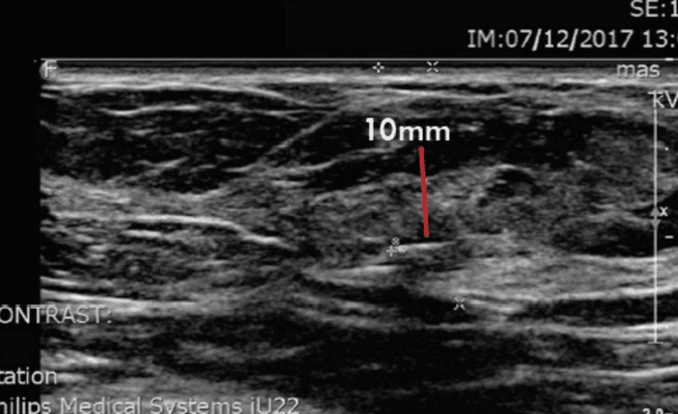 Measurement to Tumor in Supine Position Differs