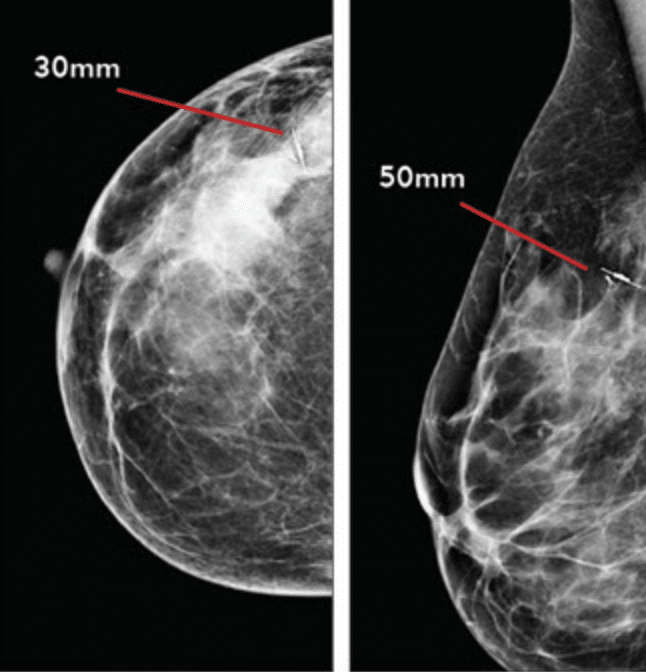 Mammographic Upright Views Prior to Surgery