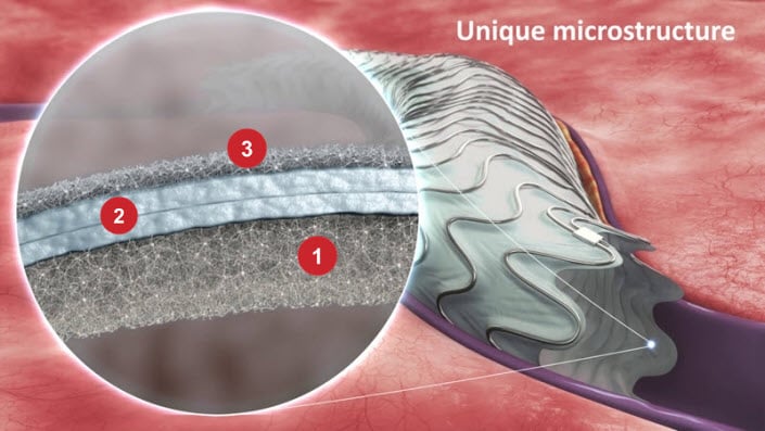 3 key elements of the Merit WRAPSODY Endoprosthesis