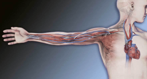 Diagrama de corte frontal Hero Graft da inserção do enxerto no paciente