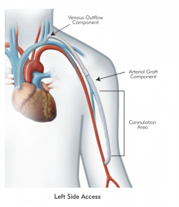 Diagram of left side HeRO Graft insertion into patient