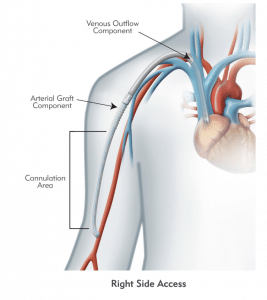 Implant site diagram left side insertion of HeRO graft