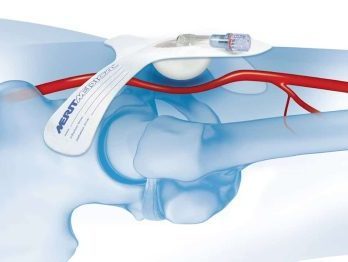 SafeGuard Compression Device [In-Service]