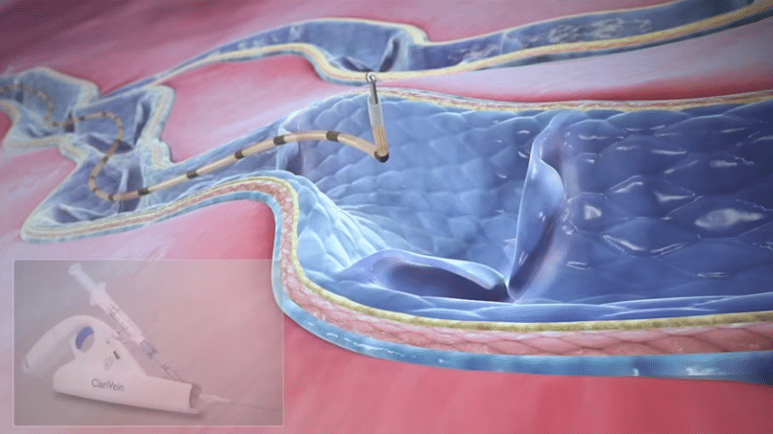 ClariVein IC Infusion Catheter [Introduction]