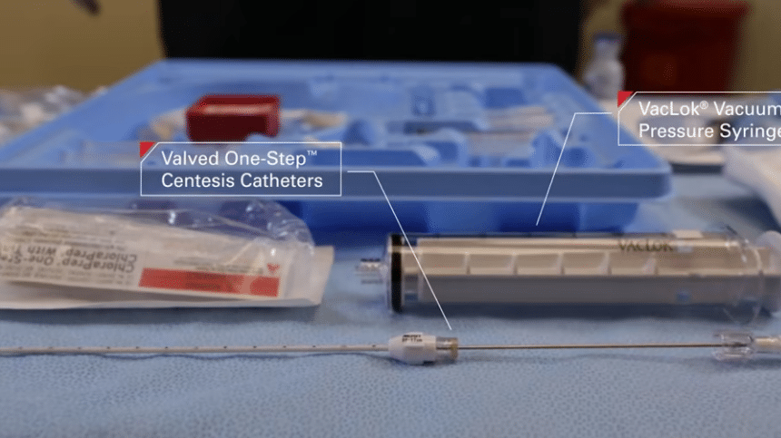 Valved One-Step Centesis Catheter