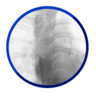 Totally occluded superior vena cava