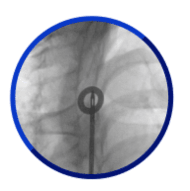Exit target provides a zone position to Surfacer Device to exit the skin