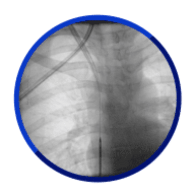 Introducer Sheath Locked Onto Needle Wire and Pulled Into Right Atrium