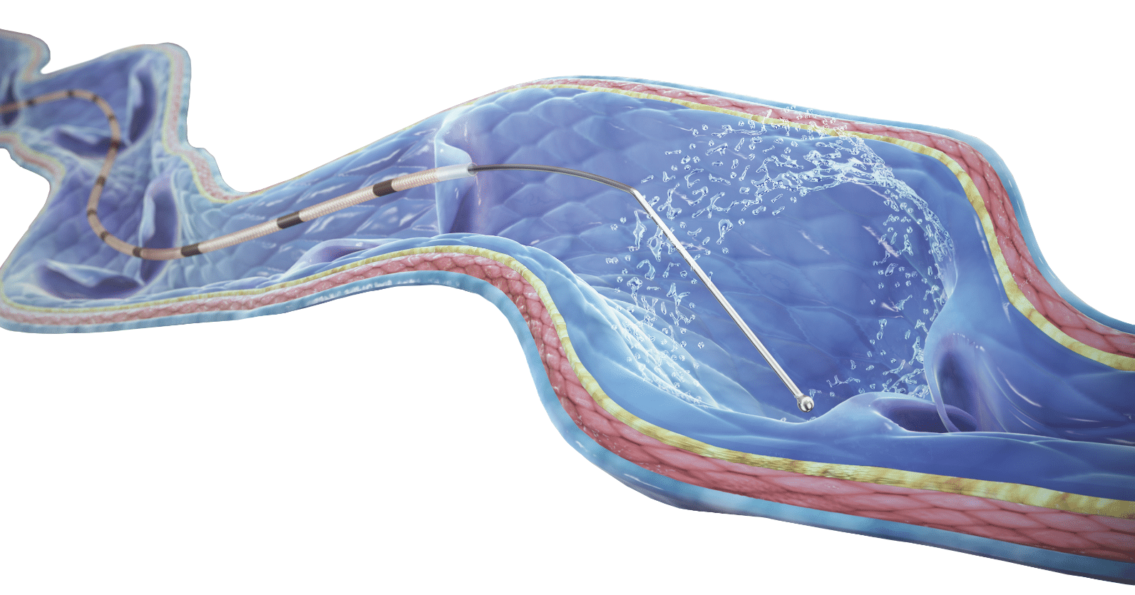 ClariVein® IC Infusion Catheter - Minimal Recovery. Maximum Results.