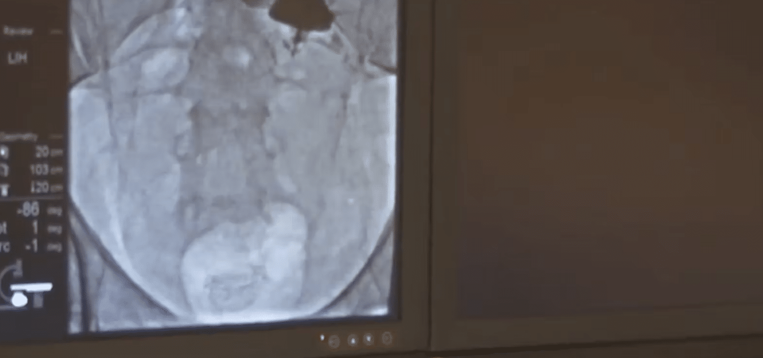 PD Percutaneous Implantation with Flex-Neck Catheters