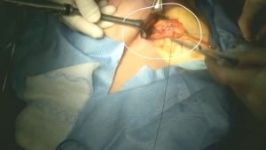LUMPECTOMY ANNOATION WITH DR. ROSEN