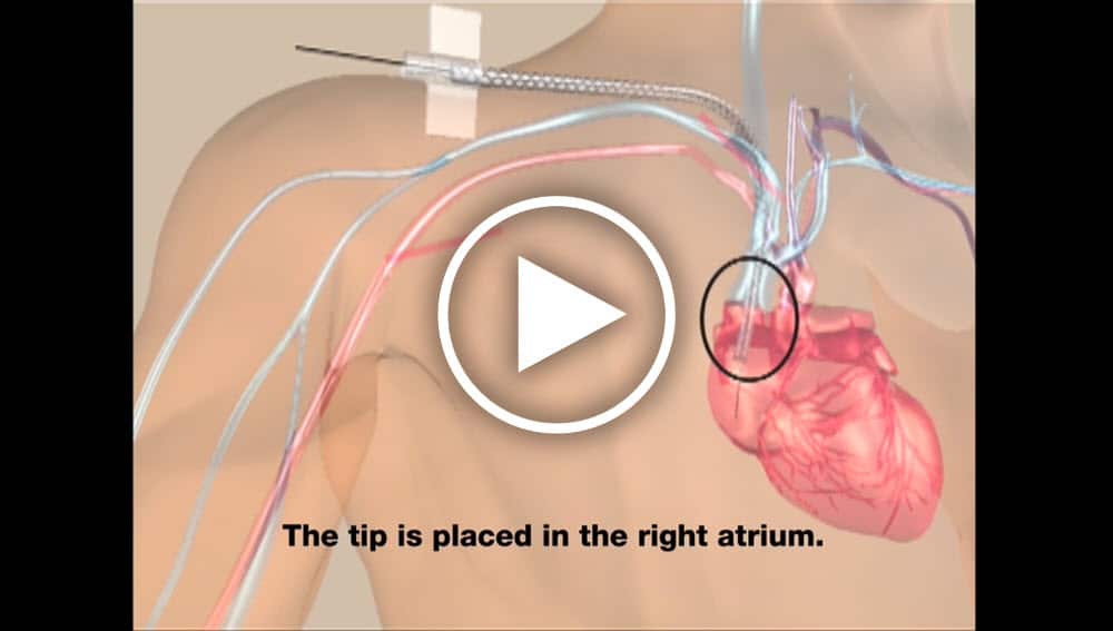 A quick animation of how to implant the HeRO Graft and cannulate the ePTFE graft.